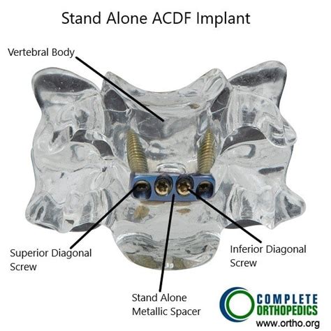 Cervical spine fusion- Minimally invasive | Complete Orthopedics | Multiple NY Locations