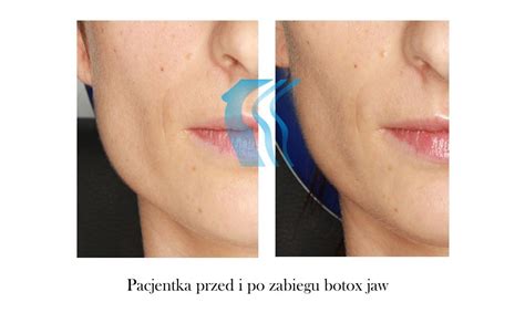 Archiwa Botox Jaw Before And After Pozna Biogenica