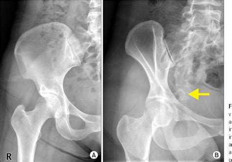 Figure From Osteochondroma Arising From Anterior Inferior Iliac Spine