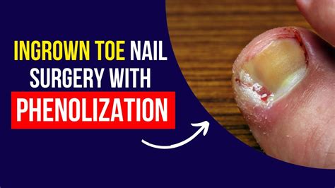 Ingrown Toe Nail Surgery In The Podiatry Clinic With Phenolization