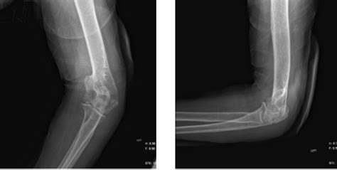 Case Study Elbow Bursectomy Right Olecranon In A 74 Year Old Female