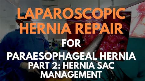 Laparoscopic Hernia Repair For Paraesophageal Hernia Part 2 Sac