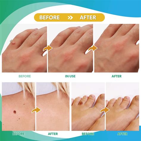 can cut off a skin tag 9