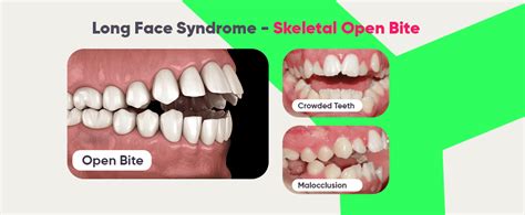 Long Face Syndrome: Symptoms and How to Fix Mouth Breathing Face ...