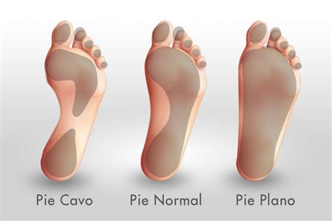 Enfermedades Metatarsalgia Pie Cavo Y Ti A Ped S O Pie De Atleta