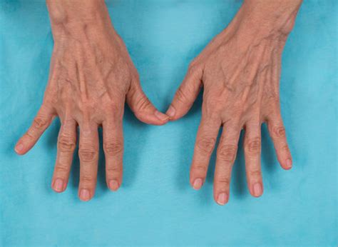 ulnar deviation images browse  stock  vectors  video