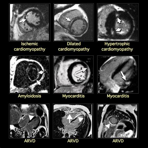 Mri Blog Imagery Of Cardiac Pathology