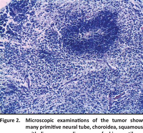 Figure From Immature Teratoma Of The Posterior Fossa In An Infant