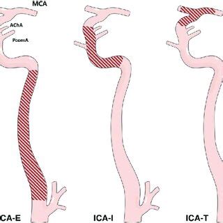 Occlusion patterns of the internal carotid artery. ACA, anterior... | Download Scientific Diagram