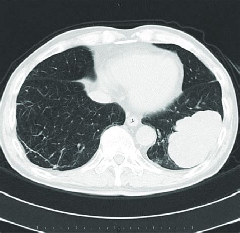 Axial Chest Computed Tomography Ct Lung Window Setting Showing 8 5