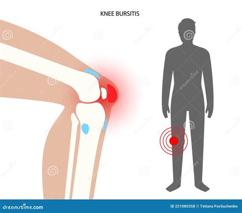 Knee Bursitis Superficial Infrapatellar Bursitis Cartoon Vector