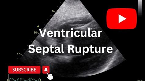 Ventricular Septal Rupture Echo Vsr Youtube