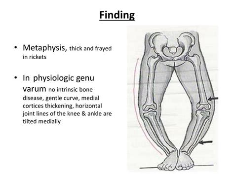 PPT - Genu valgus & Genu Varus PowerPoint Presentation - ID:550435