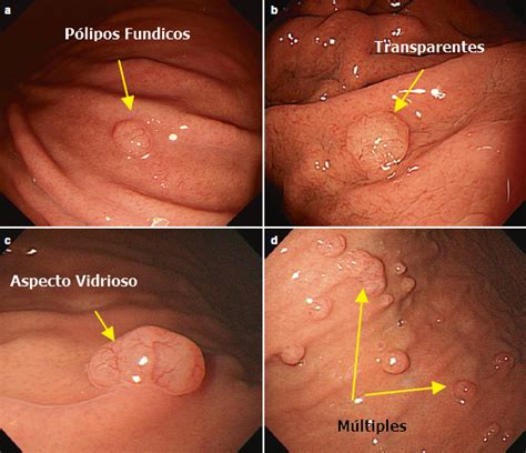 Algoritmos Para El Diagn Stico Y Manejo De Los P Lipos G Stricos