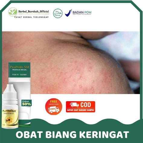 Jual Obat Oles Biang Keringat Ruam Merah Gatal Gatal Biang