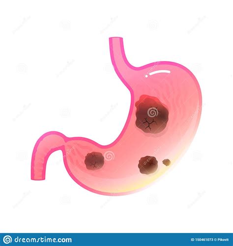 Illustration D Isolement Par Vecteur De Cancer De L Estomac