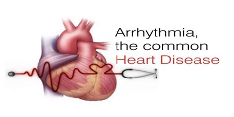 Arrhythmia Causes Symptoms And Treatment Assignment Point