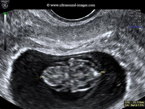 Ultrasound Images of Fetal General