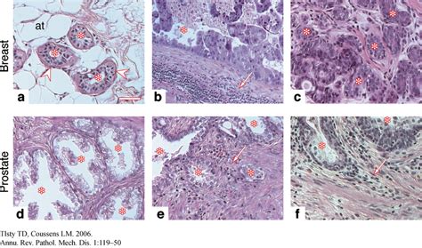 Stromal Responses In Breast And Prostate Carcinogenesis A Normal