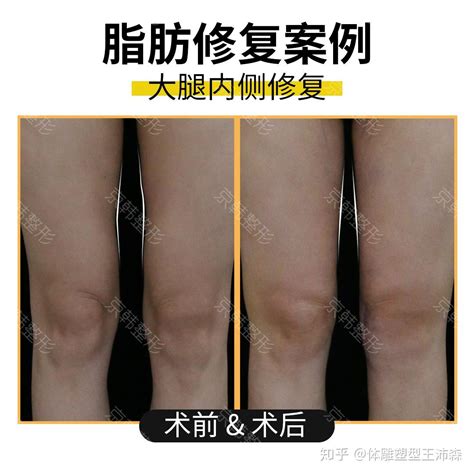 大腿吸脂失败有哪些现象？如何才能有效避免吸脂手术失败？ 知乎