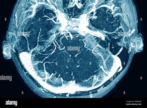 Trombosis Senos Venosos Cerebrales Howtodoes