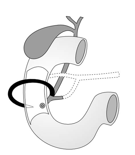 Annular Pancreas Embryology