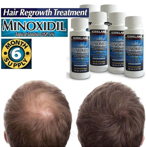 6 Month Supply Kirkland Minoxidil 5 Extra Strength Hair Men Regrowth