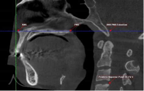 Evaluation Of The Pharyngeal Airway Space Before And After Bi Lateral