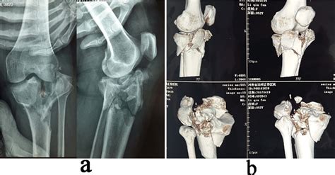 A Year Old Female Patient With An Old And Complex Tibial Plateau