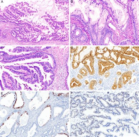 Mucinous Borderline Tumor Mbt Intracystic Epithelial Proliferation