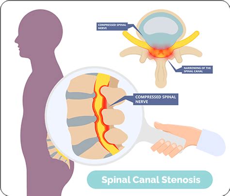 Do Healthy Lifestyle Changes Make A Difference In Spinal Canal Stenosis? - Health Guide Insider