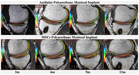 First Clinical Application Of Polyurethane Meniscal Scaffolds With