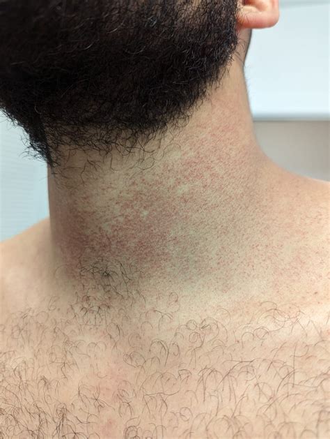 Rash On Neck R Dermatologyquestions