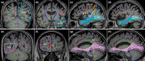 Identification Of The Inferior Longitudinal Fasciculus And Inferior