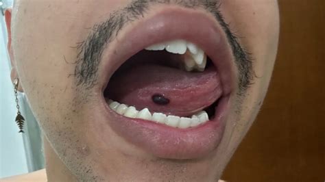 Bolha Preta Na Boca