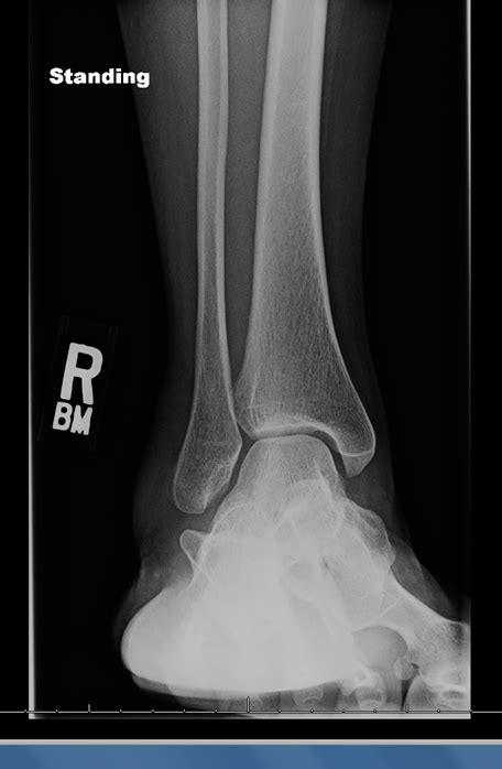 ball and socket ankle joint | The Foot and Ankle Online Journal