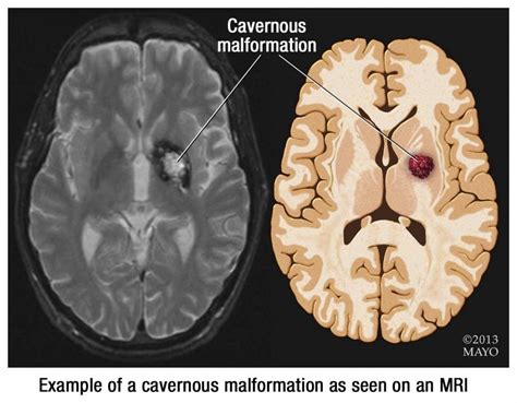 Mayo Clinic Named Center Of Excellence For Cavernous Malformation Treatment Research Mayo