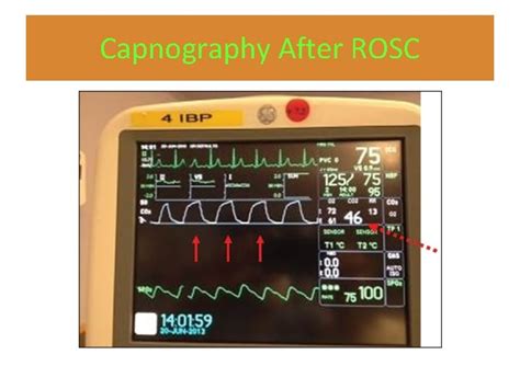 Postcardiac Arrest Care Aha 2015 Dr Nahid Zirak