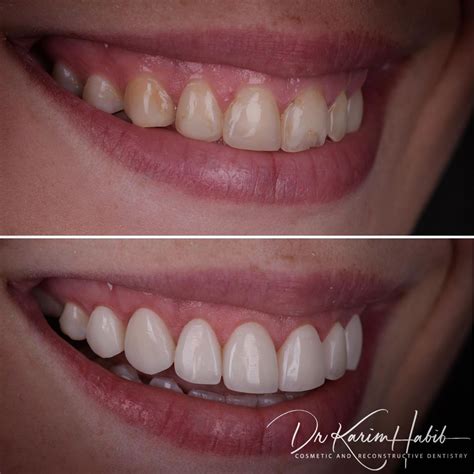 Composite Veneers Sydney Dental Bonding Sydney Dentist Ryde