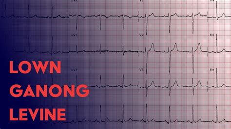 Lown Ganong Levine Ecg Ekg Interpretation Youtube