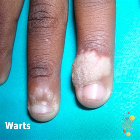 Skin Lesions On Fingers