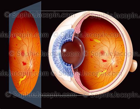 RÉTINOPATHIE DIABÉTIQUE illustration medicale Sophie Jacopin