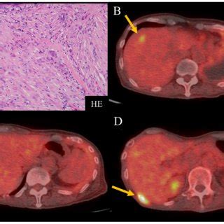 Pathological Findings And Fdg Based Positron Emission Tomography Ct