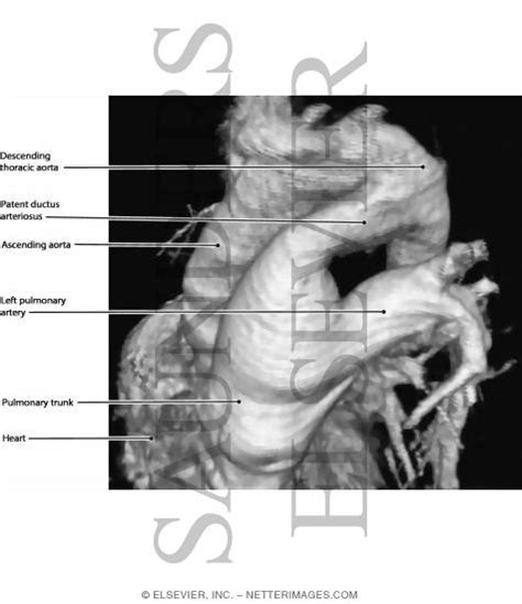 ligamentum arteriosum Archives - Thai Wikipedia Change