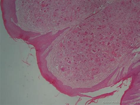 Epulis Histology