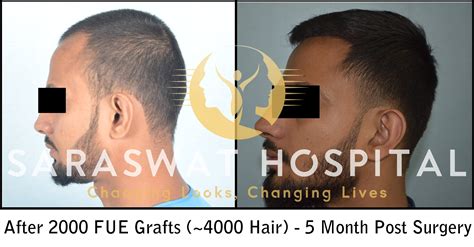 Hair Transplantation Before And After Results Saraswat Hospital