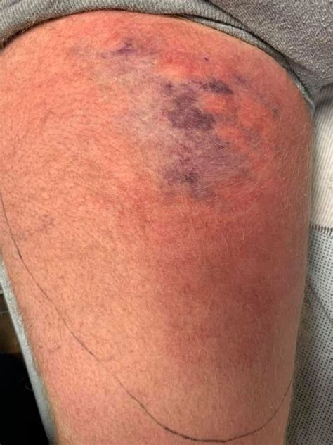 Alabama Man Gets Flesh Eating Bacteria On Kayaking Trip