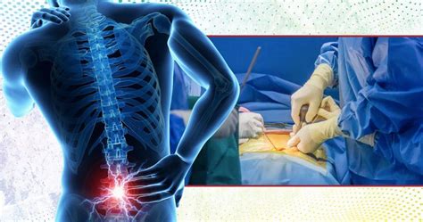 7 Newest Treatments For Spinal Stenosis In 2024