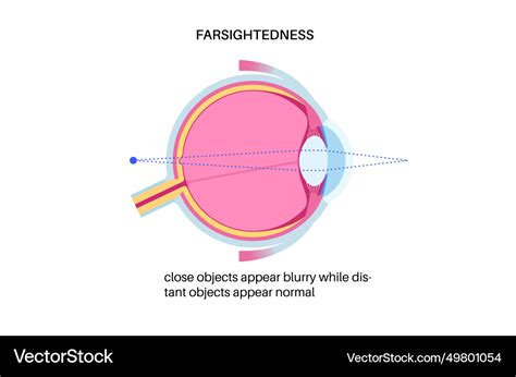 farsightedness eye disease royalty  vector image