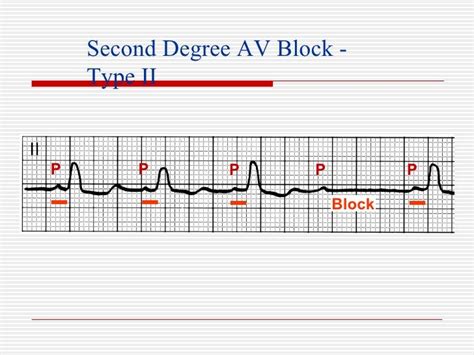 Ecg Conduction Block